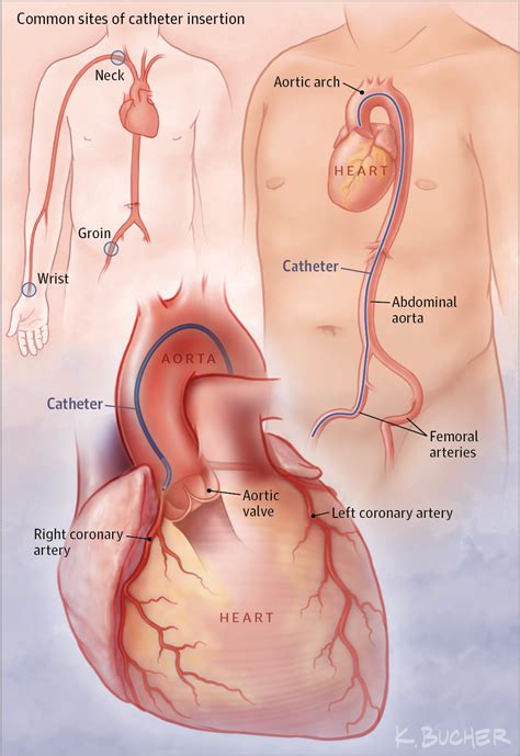 Cardiac Catheterization. | Cardiology | JAMA | JAMA Network