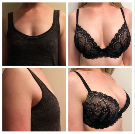 Collection 96+ Pictures Breast Augmentation Surgery Pictures Excellent