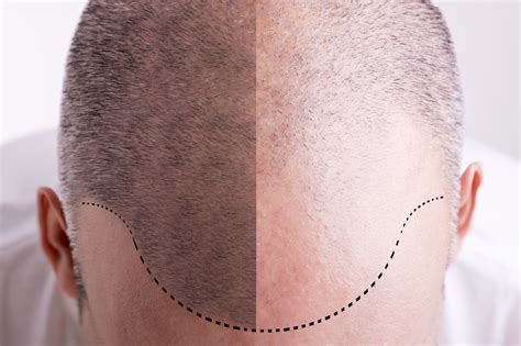 What makes a good candidate for Hair Transplant surgery? - Ape to Gentleman