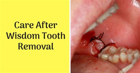 medicine after wisdom teeth removal - lacsonroegner-99