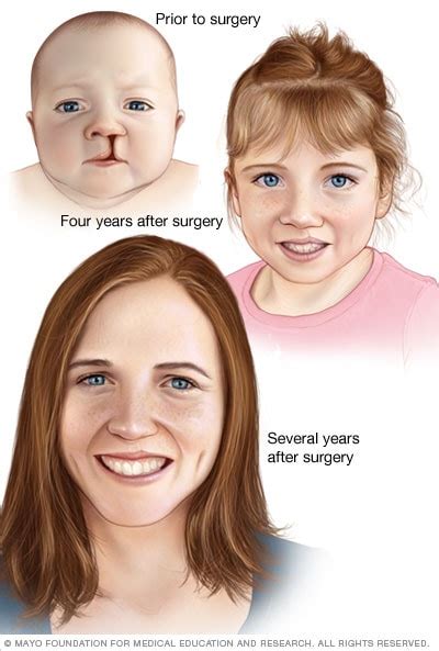 Cleft lip and cleft palate - Diagnosis and treatment (2023)