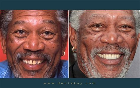 6 Shocking celebrity veneers with before & after pictures