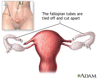 Tubal ligation - Series—Procedure: MedlinePlus Medical Encyclopedia