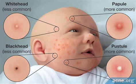 Baby Acne: What Is It, and What Causes It?