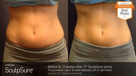 SculpSure before and after Photos: Real Patient Results - New Beauty ...