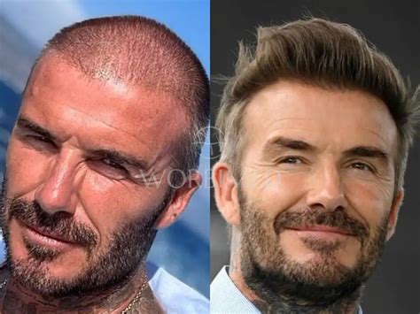 David Beckham Hair Transplant | Before and After