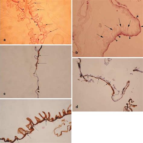 Cellophane maculopathy cases. a , b H&E staining shows hyperconvolution ...