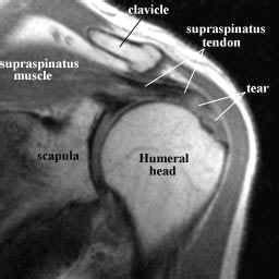 Mri, Shoulder anatomy, Supraspinatus muscle