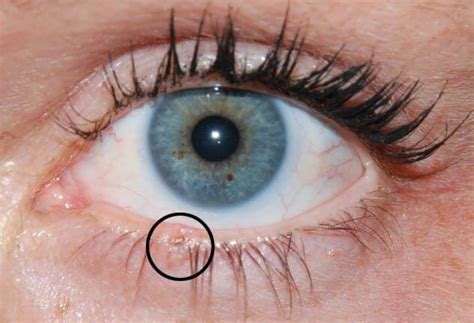 Basal Cell Carcinoma On Lower Eyelid