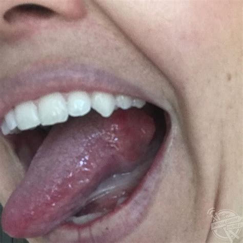 This Mum Had A Shock When A Bump On Her Tongue Ended Up Being Cancer ...