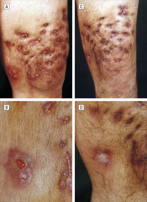 Nocardia otitidiscaviarum: Cause of Long-term Cutaneous Abscesses on ...