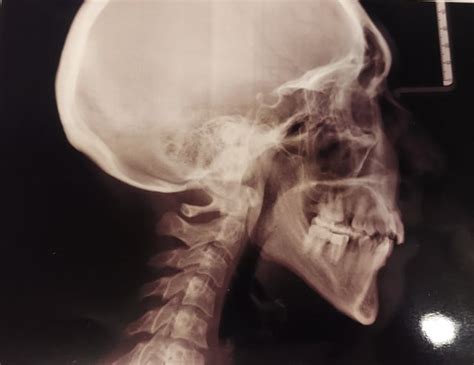 Do I have the Melungeon bump on my skull? : r/Melungeon