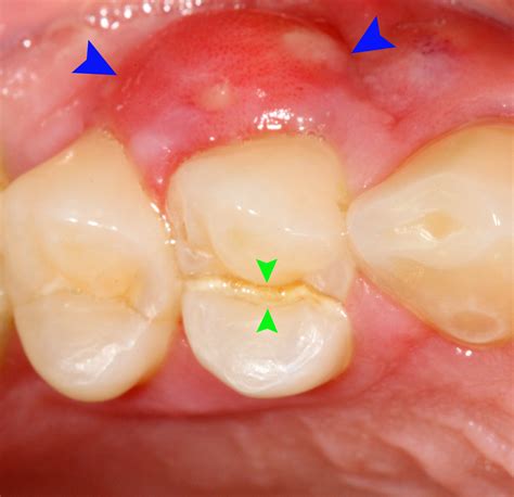 Complications of tooth abscess | General center | SteadyHealth.com