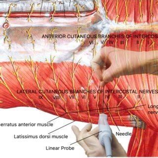 Ultrasound-guided serratus anterior plane block. Ultrasound transducer ...