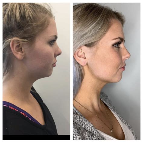 Medical Kybella Injections in Gilbert | Colair Med Spa