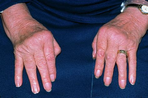 Rheumatoid Arthritis Ulnar Deviation Caption Update - vrogue.co