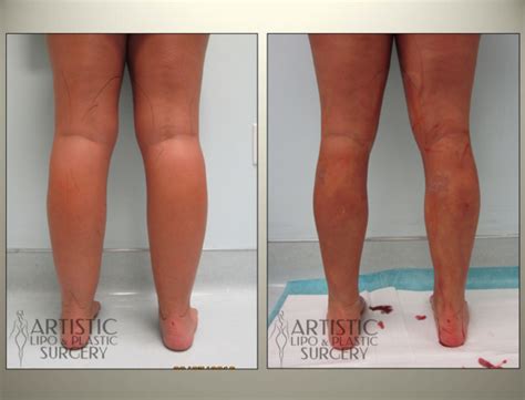 Lipedema Surgery Before and After Results - Art Lipo