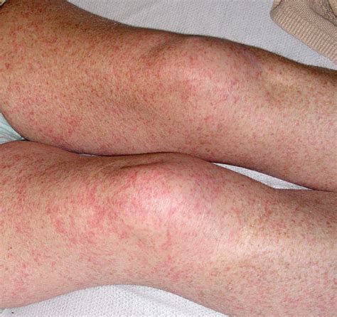 Petechial Rash on the Thighs in an Immunosuppressed Patient | MDedge Dermatology