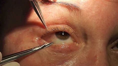 Management of Post-Blepharoplasty Chemosis - YouTube