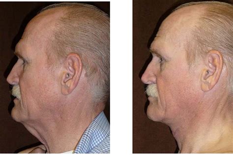 Male Neck Lift Procedure in Fort Worth | Neck Skin Reduction