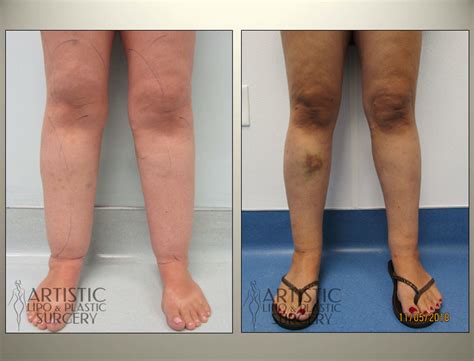 Lipedema Surgery Before and After Results - Art Lipo