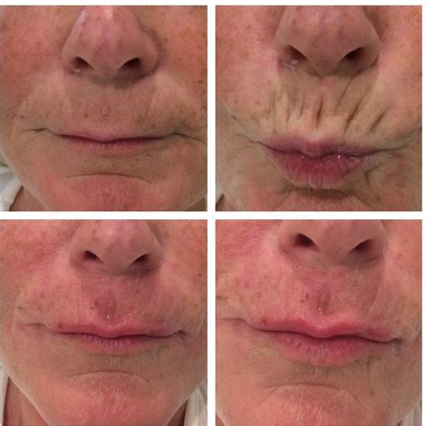 Before & After PDO Threads to top lip at AB Medical UK priced at £360 ...