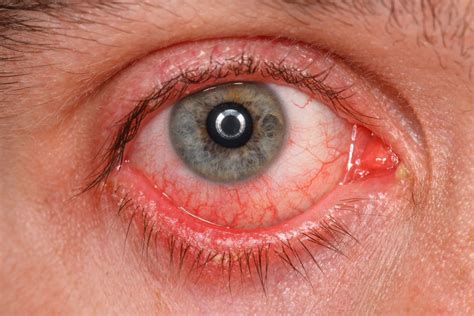 Inflammatory Eye Disease – AZIV Infusion Therapy Center