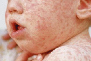 Meningitis Viral Rash Baby / Rashes In Babies And Children Nhs - just ...