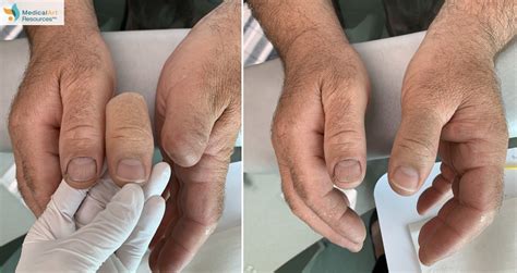 Finger and Hand Prosthesis Photos | Medical Art Resources — Life-like Prosthetics