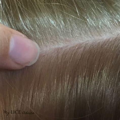Lice in Blonde Hair: Lice and Lice Eggs Pictures in Blondes