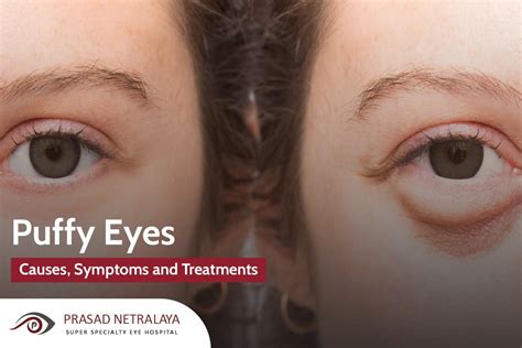 Causes, Symptoms and Treatments For Puffy Eyes