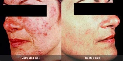 Rosacea Treatment Photos | Rosacea.org