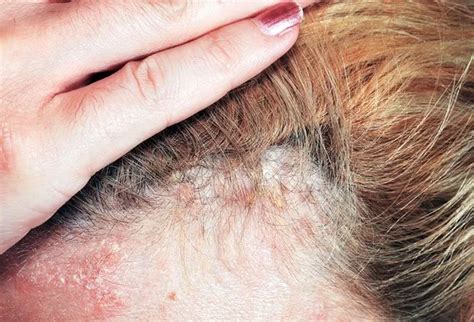 Scalp Psoriasis Vs. Dandruff: Treatments & Symptoms