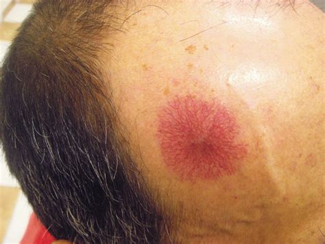 Angioma, Hemangioma Venous Lake treatments | Messina Esthetics