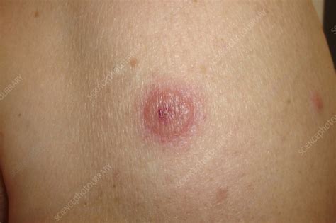 Neutrophilic dermatosis in Sweet's disease - Stock Image - C048/2938 - Science Photo Library