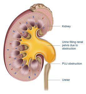 Pyeloplasty - Brisbane Urology Clinic