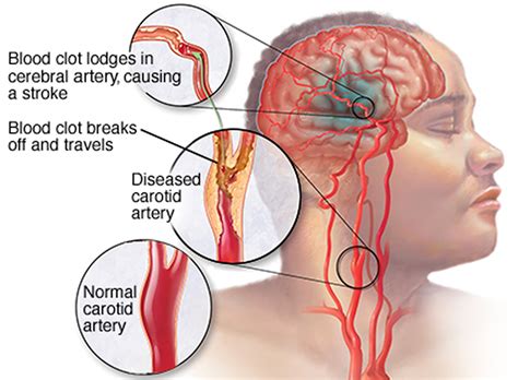 Ischemic Stroke - Causes, Signs, Symptoms & Ischemic Stroke Treatment