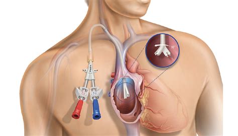 The Pristine™ Long-Term Hemodialysis Catheter: Physicians’ Perspectives ...