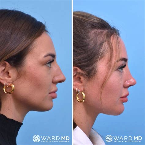 Rhinoplasty Side Profile Before & After | Nose plastic surgery, Nose ...