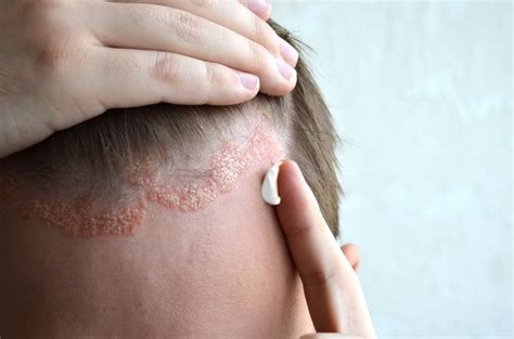 Scalp psoriasis