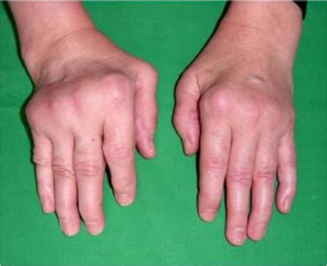 Rheumatoid Arthritis Hands