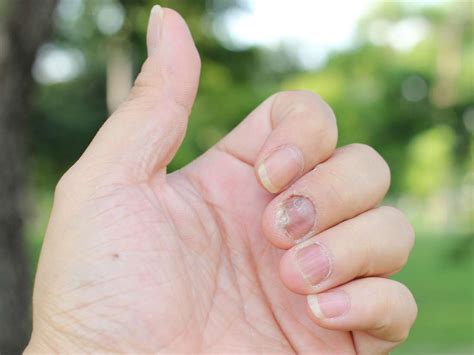 Nail psoriasis: What is it, treatment, and home remedies
