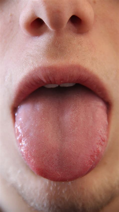 Tongue Discoloration: Symptoms, Causes, and Treatments - Aldie Family & Cosmetic Dentistry