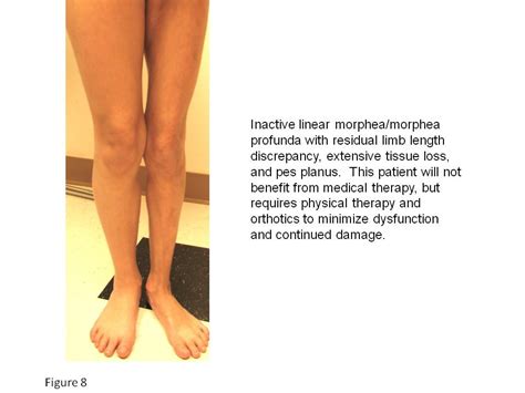 Morphea (Localized Scleroderma) - Dermatology Advisor