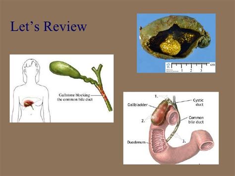 B75 chapter 24 gallbladder, liver and pancreatic disorder