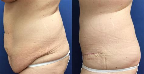 Panniculectomy Before & After Photos Patient 297 | Ann Arbor, MI | Center for Plastic ...