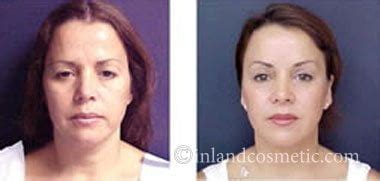 Rancho Cucamonga Brow Lift | Inland Cosmetic Surgery