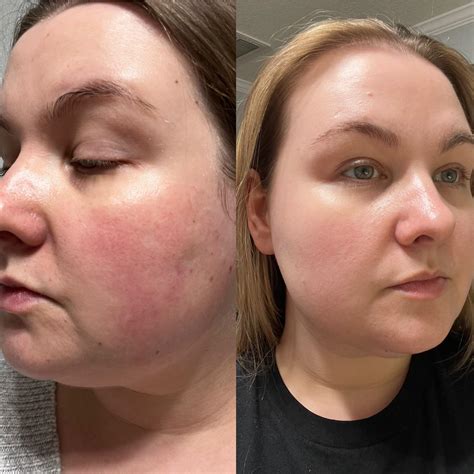 If you’re thinking about BBL, do it. : r/Rosacea