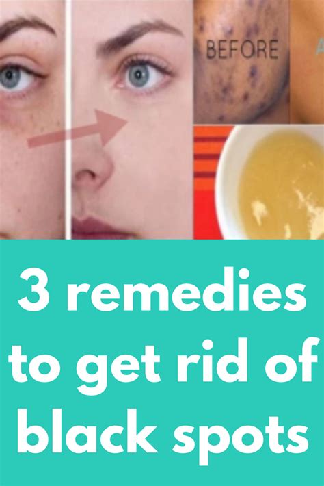 3 remedies to get rid of black spots in just 15 minutes | Black spot ...