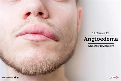 11 Causes Of Angioedema And Its Prevention! - By Dr. Manju Keshari ...